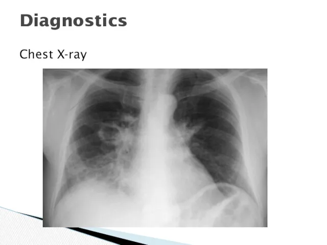 Chest X-ray Diagnostics