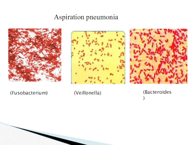 Aspiration pneumonia (Fusobacterium) (Bacteroides) (Veillonella)