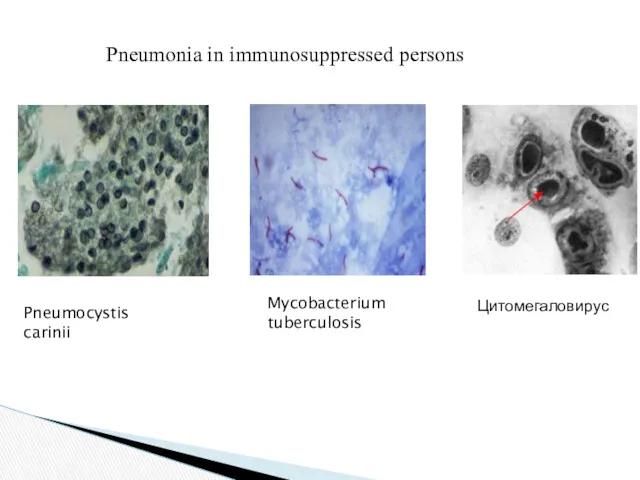 Pneumonia in immunosuppressed persons Pneumocystis carinii Mycobacterium tuberculosis Цитомегаловирус