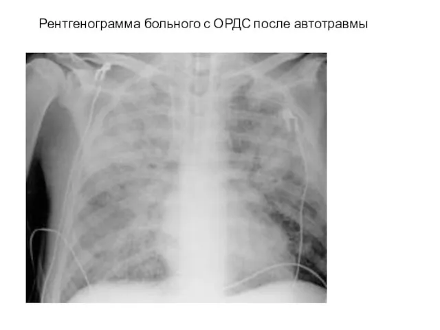 Рентгенограмма больного с ОРДС после автотравмы