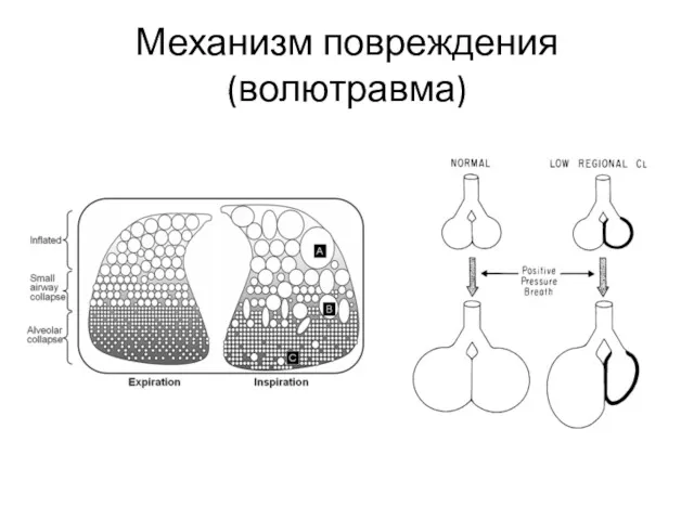 Механизм повреждения (волютравма)