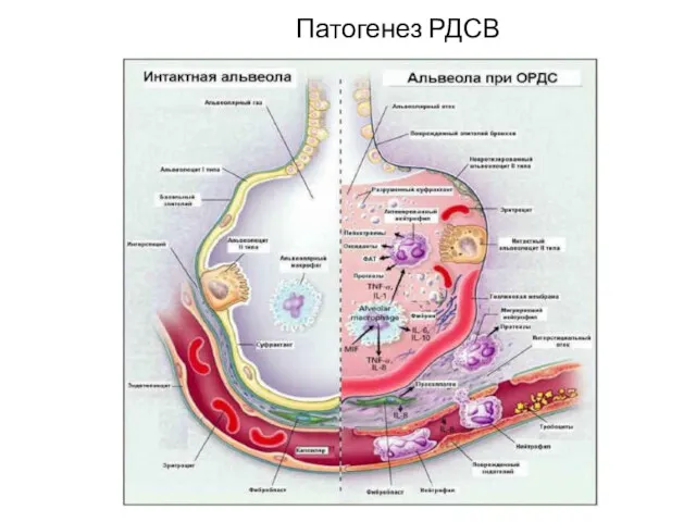 Патогенез РДСВ