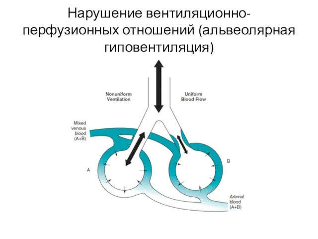 Нарушение вентиляционно-перфузионных отношений (альвеолярная гиповентиляция)