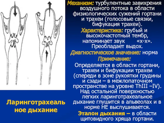 Ларинготрахеаль ное дыхание Механизм: турбулентные завихрения воздушного потока в области