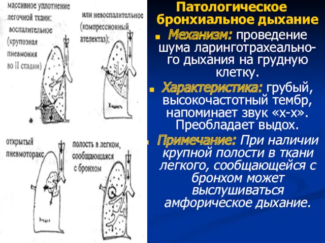 Патологическое бронхиальное дыхание Механизм: проведение шума ларинготрахеально-го дыхания на грудную