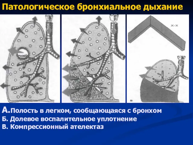 Патологическое бронхиальное дыхание А.Полость в легком, сообщающаяся с бронхом Б. Долевое воспалительное уплотнение В. Компрессионный ателектаз