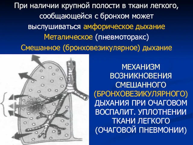 При наличии крупной полости в ткани легкого, сообщающейся с бронхом