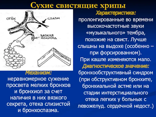 Сухие свистящие хрипы Механизм: неравномерное сужение просвета мелких бронхов и