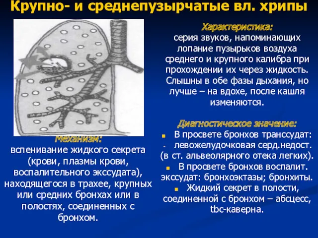 Крупно- и среднепузырчатые вл. хрипы Механизм: вспенивание жидкого секрета (крови,