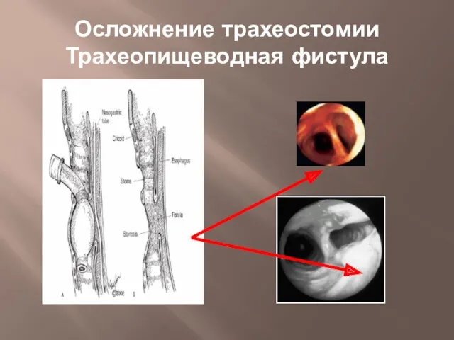 Осложнение трахеостомии Трахеопищеводная фистула