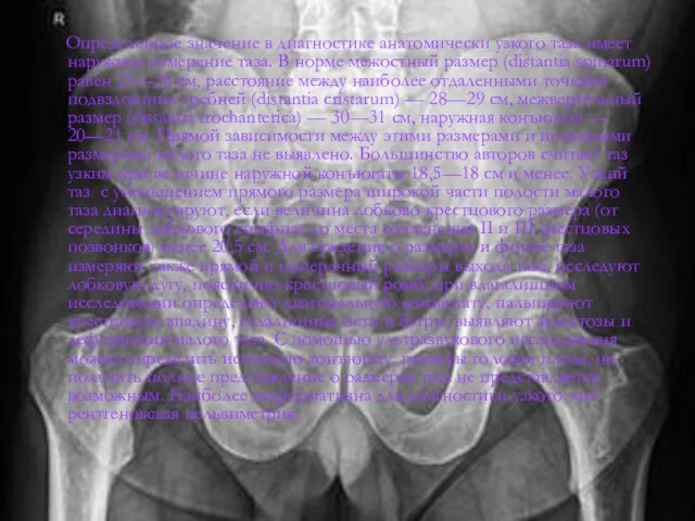 Определенное значение в диагностике анатомически узкого таза имеет наружное измерение таза. В норме