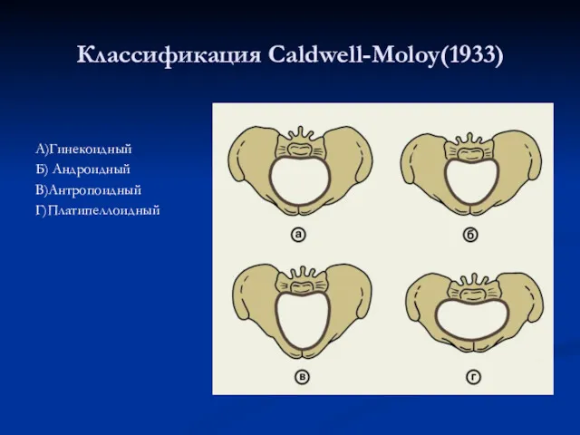 Классификация Caldwell-Moloy(1933) А)Гинекоидный Б) Андроидный В)Антропоидный Г)Платипеллоидный