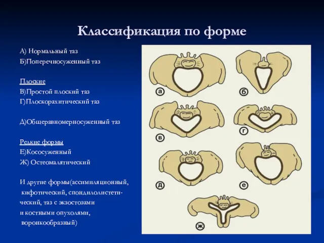 Классификация по форме А) Нормальный таз Б)Поперечносуженный таз Плоские В)Простой плоский таз Г)Плоскорахитический
