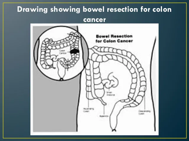 Drawing showing bowel resection for colon cancer
