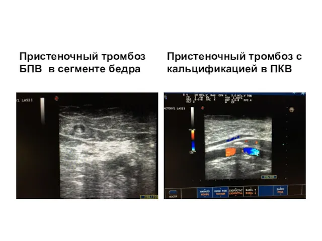 Пристеночный тромбоз БПВ в сегменте бедра Пристеночный тромбоз с кальцификацией в ПКВ
