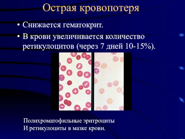 Острая кровопотеря Снижается гематокрит. В крови увеличивается количество ретикулоцитов (через
