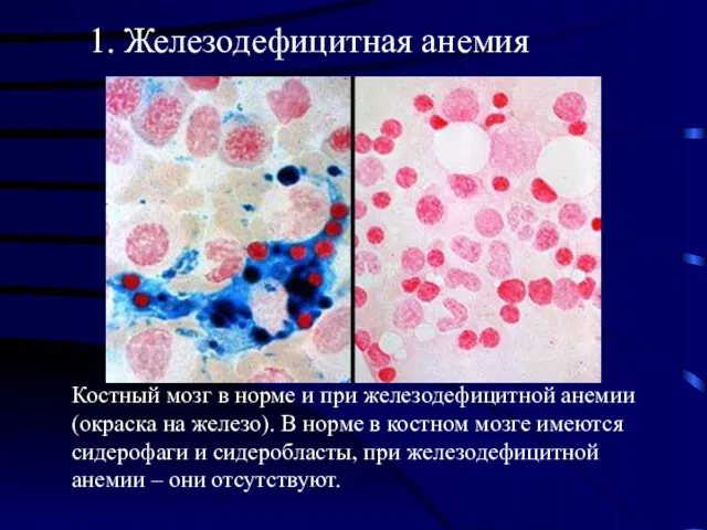 Костный мозг в норме и при железодефицитной анемии (окраска на