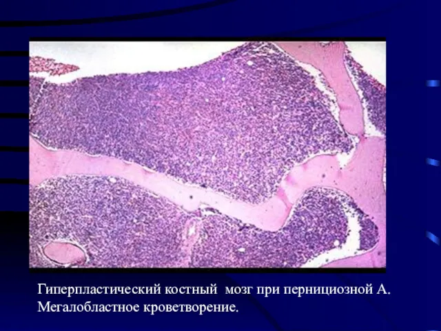 Изменения в организме Меглобластная анемия Гиперпластический костный мозг при пернициозной А. Мегалобластное кроветворение.