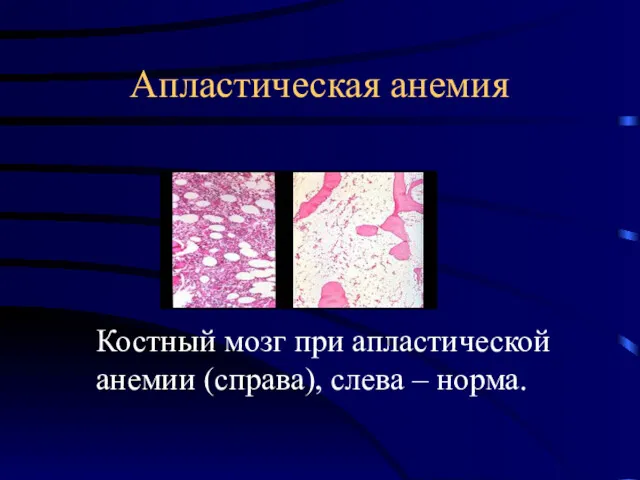 Апластическая анемия Костный мозг при апластической анемии (справа), слева – норма.