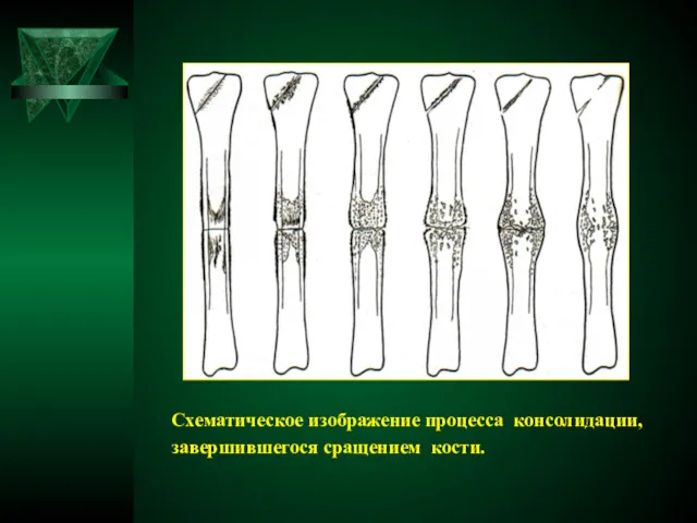 Схематическое изображение процесса консолидации, завершившегося сращением кости.