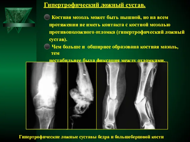 Гипертрофический ложный сустав. ⚫ Костная мозоль может быть пышной, но