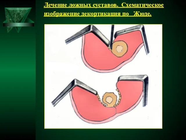 Лечение ложных суставов. Схематическое изображение декортикация по Жюде.