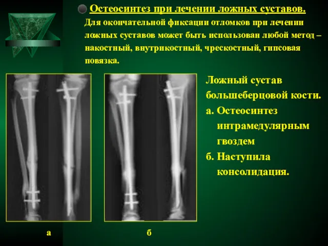 ⚫ Остеосинтез при лечении ложных суставов. Для окончательной фиксации отломков