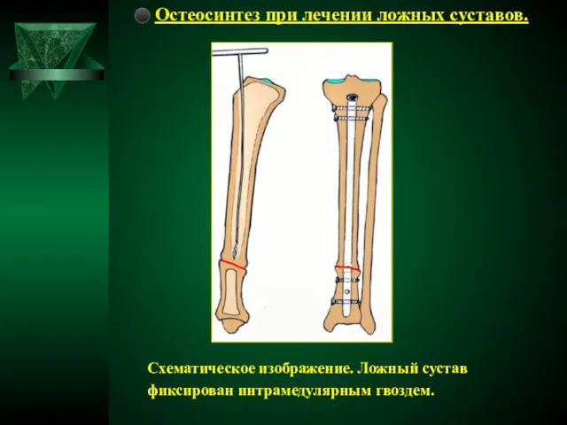 ⚫ Остеосинтез при лечении ложных суставов. Схематическое изображение. Ложный сустав фиксирован интрамедулярным гвоздем.