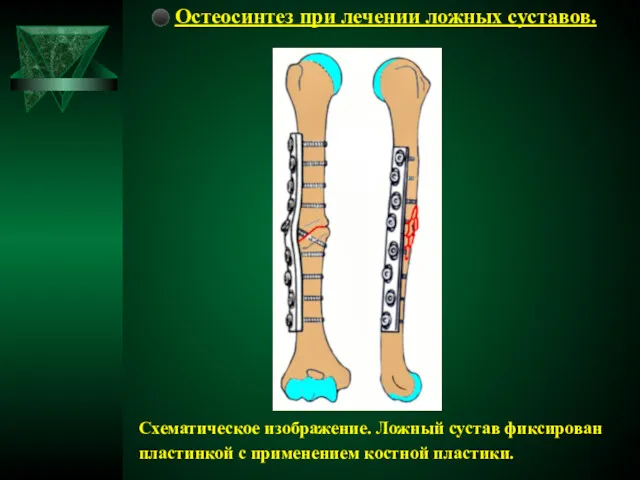 ⚫ Остеосинтез при лечении ложных суставов. Схематическое изображение. Ложный сустав фиксирован пластинкой с применением костной пластики.