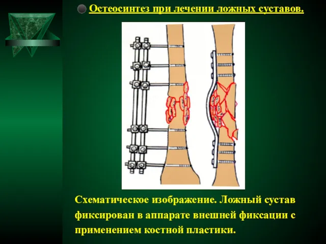 ⚫ Остеосинтез при лечении ложных суставов. Схематическое изображение. Ложный сустав