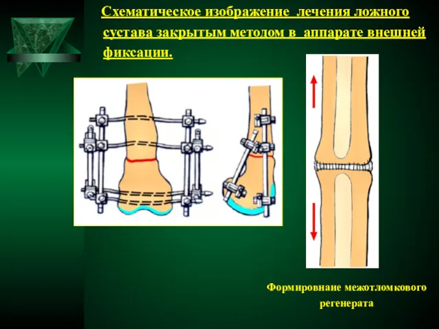 Схематическое изображение лечения ложного сустава закрытым методом в аппарате внешней фиксации. Формировнаие межотломкового регенерата