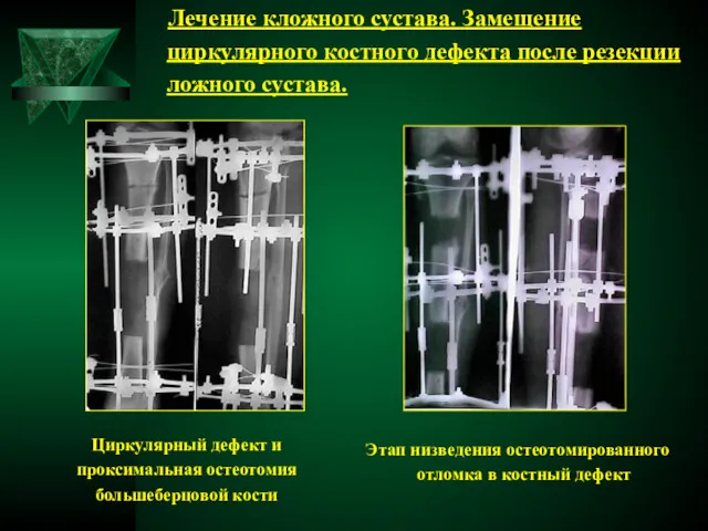 Лечение кложного сустава. Замещение циркулярного костного дефекта после резекции ложного