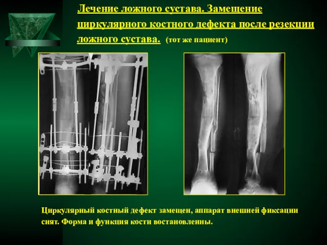 Лечение ложного сустава. Замещение циркулярного костного дефекта после резекции ложного