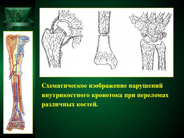 Схематическое изображение нарушений внутрикостного кровотока при переломах различных костей.