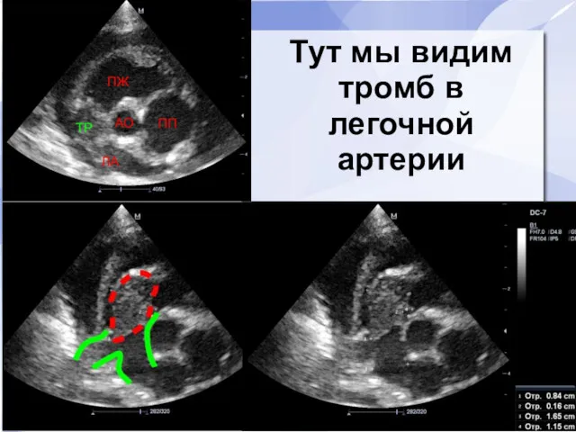 Тут мы видим тромб в легочной артерии