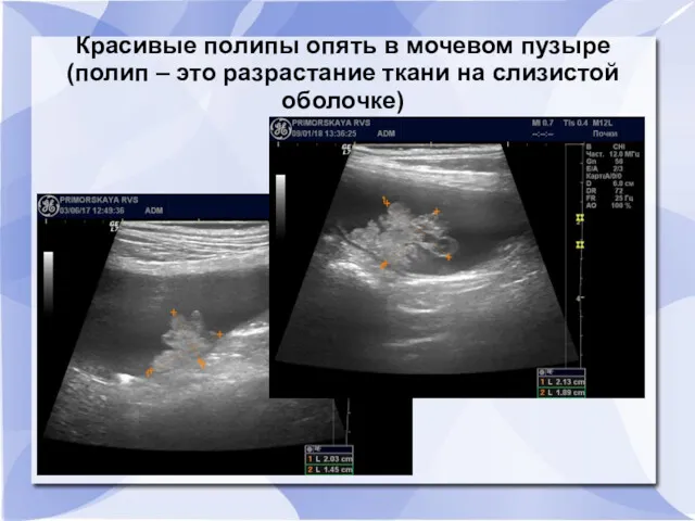 Красивые полипы опять в мочевом пузыре (полип – это разрастание ткани на слизистой оболочке)