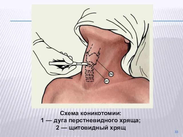 Схема коникотомии: 1 — дуга перстневидного хряща; 2 — щитовидный хрящ