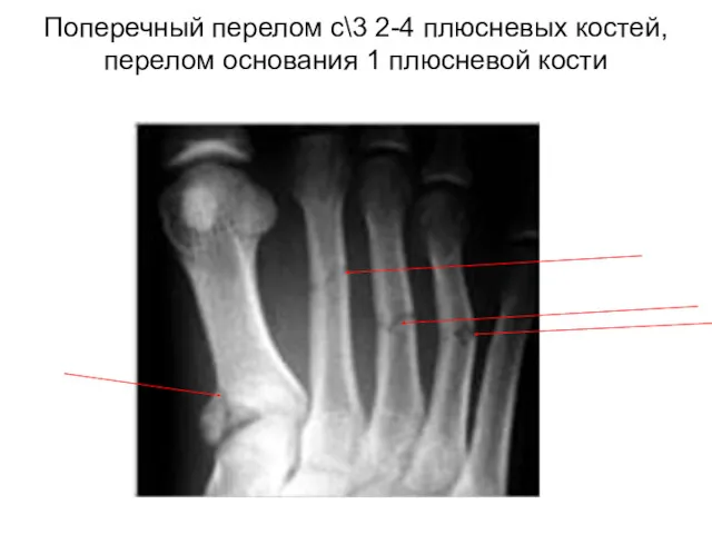 Поперечный перелом с\3 2-4 плюсневых костей, перелом основания 1 плюсневой кости