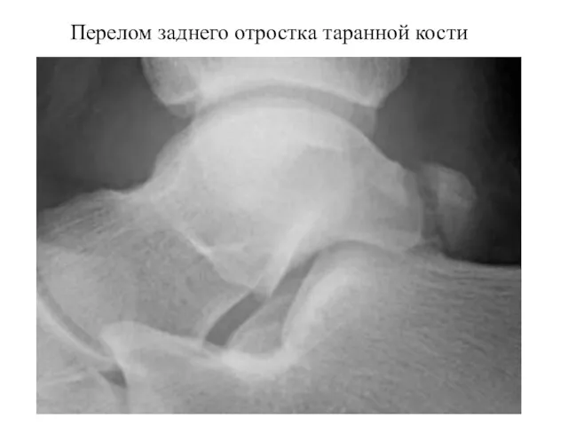 Перелом заднего отростка таранной кости