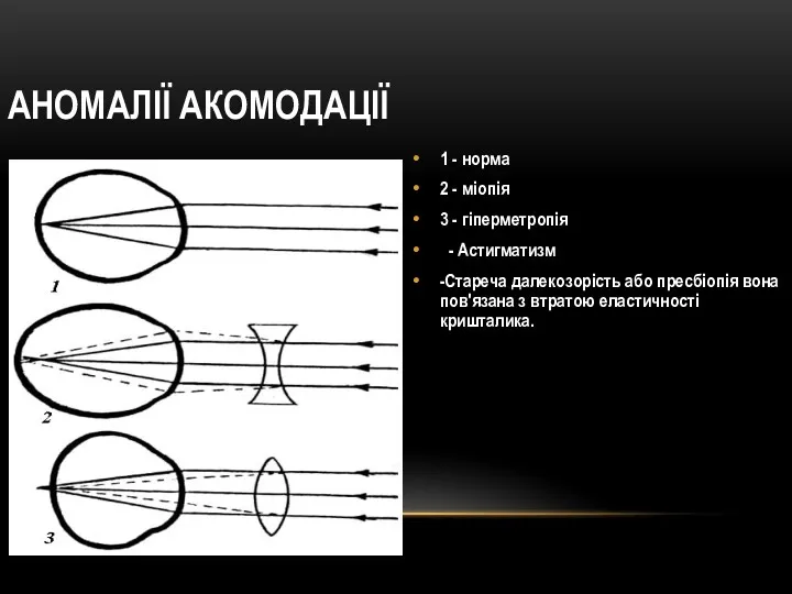 АНОМАЛІЇ АКОМОДАЦІЇ 1 - норма 2 - міопія 3 -