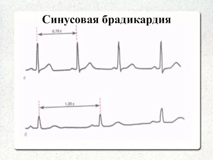 Синусовая брадикардия