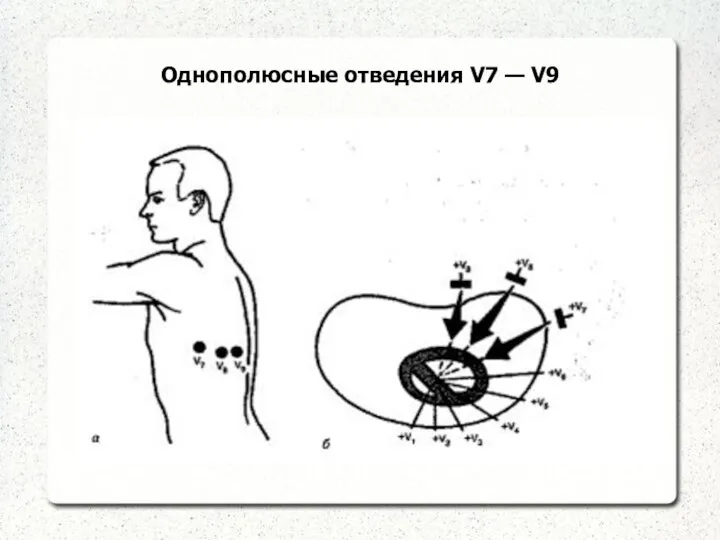 Однополюсные отведения V7 — V9