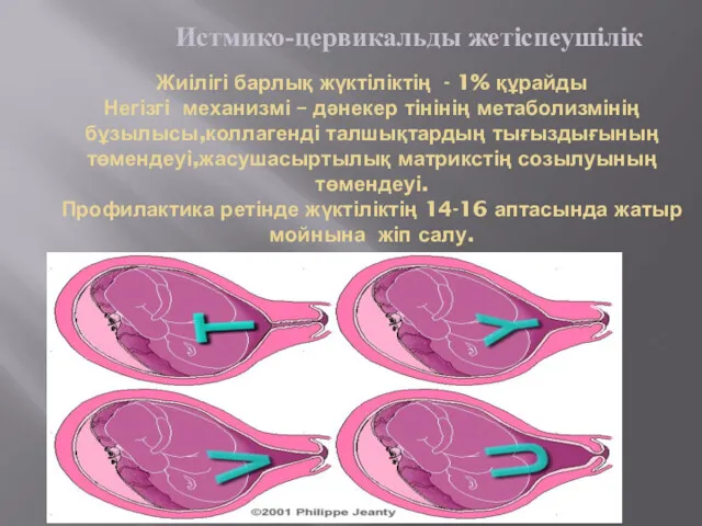 Жиілігі барлық жүктіліктің - 1% құрайды Негізгі механизмі – дәнекер