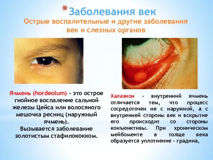 Заболевания век Ячмень (hordeolum) - это остpое гнойное воспаление сальной
