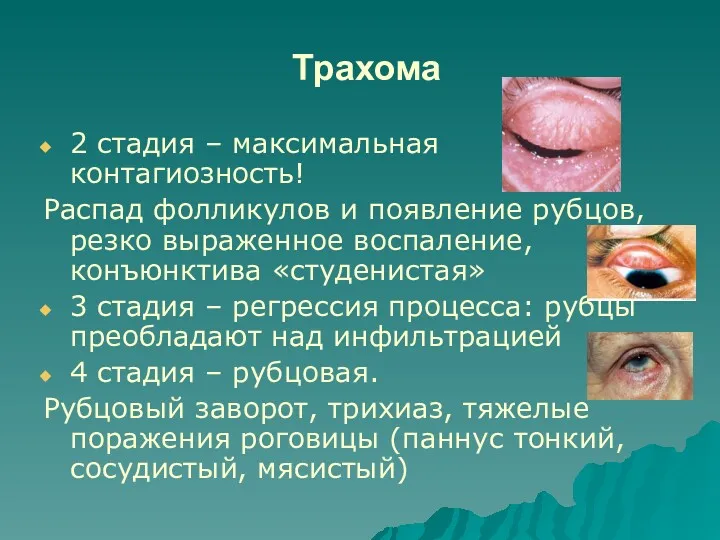 Трахома 2 стадия – максимальная контагиозность! Распад фолликулов и появление