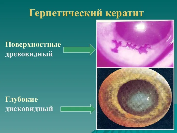 Герпетический кератит Поверхностные древовидный Глубокие дисковидный