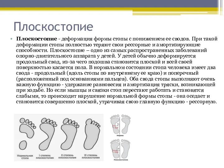 Плоскостопие Плоскостопие - деформация формы стопы с понижением ее сводов. При такой деформации