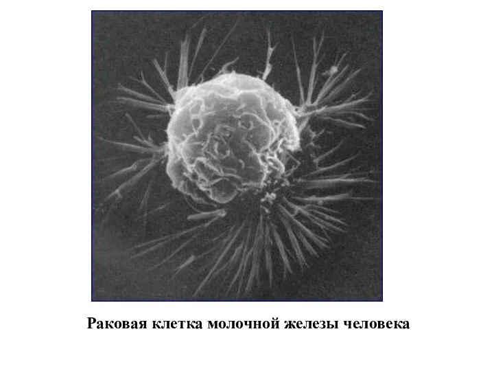 Раковая клетка молочной железы человека
