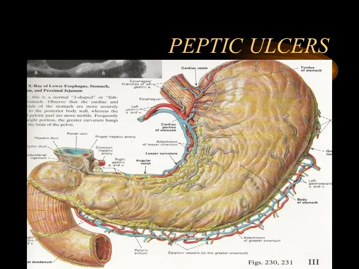 PEPTIC ULCERS