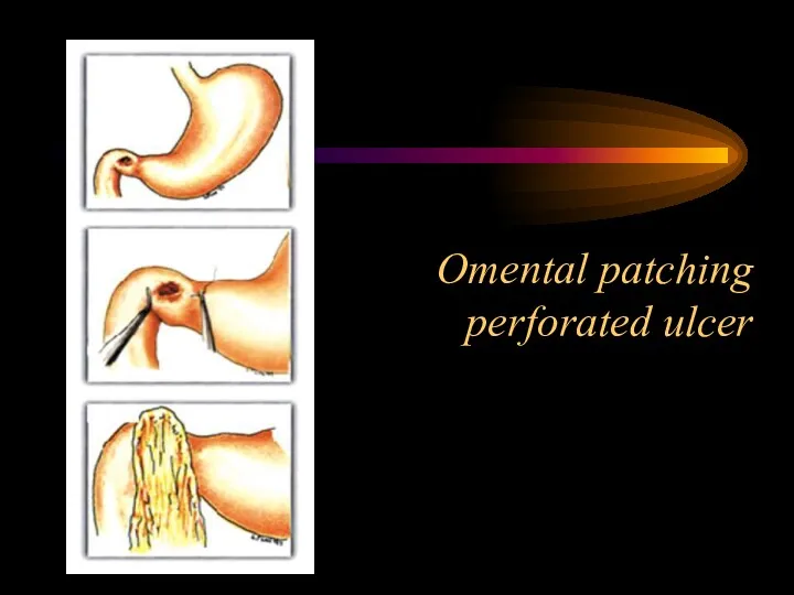 Omental patching perforated ulcer